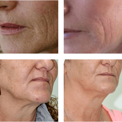 Laser Rejavenation