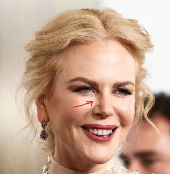 Alternatîfek to Botox